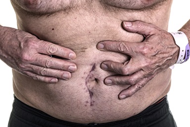 stomach with scars on it
